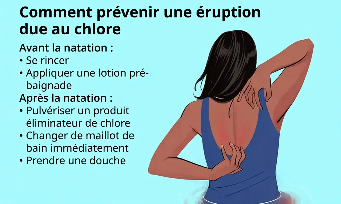 Comment prévenir une éruption due au chlore